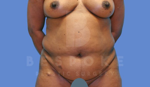 Tummy Tuck Before & After Gallery - Patient 143675812 - Image 1