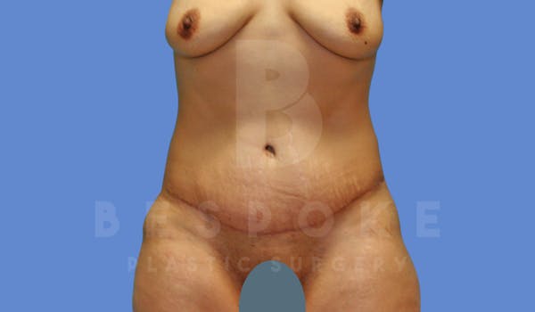 Tummy Tuck Before & After Gallery - Patient 143675811 - Image 2
