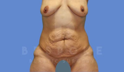 Tummy Tuck Before & After Gallery - Patient 143675811 - Image 1