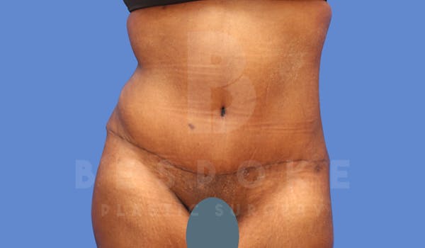 Tummy Tuck Before & After Gallery - Patient 143675810 - Image 2