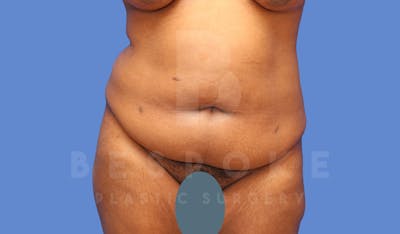 Tummy Tuck Before & After Gallery - Patient 143675810 - Image 1
