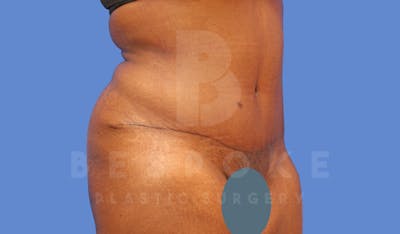 Tummy Tuck Before & After Gallery - Patient 143675810 - Image 4