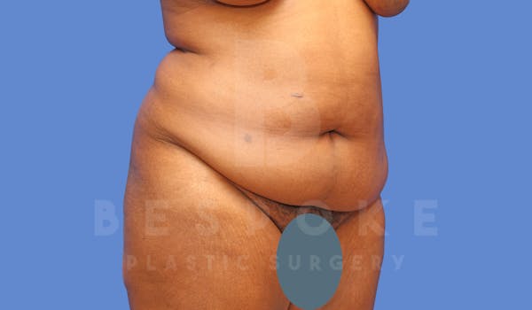 Tummy Tuck Before & After Gallery - Patient 143675810 - Image 3