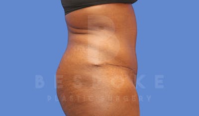 Tummy Tuck Before & After Gallery - Patient 143675810 - Image 6
