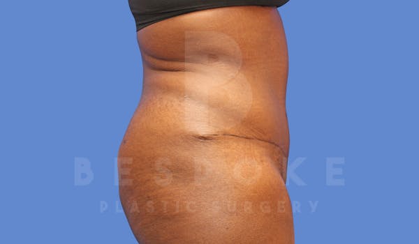 Tummy Tuck Before & After Gallery - Patient 143675810 - Image 6