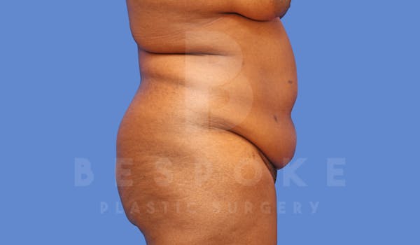Tummy Tuck Before & After Gallery - Patient 143675810 - Image 5