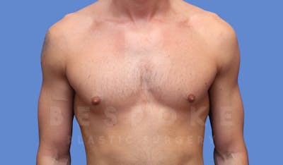 Gynecomastia Before & After Gallery - Patient 143773712 - Image 2