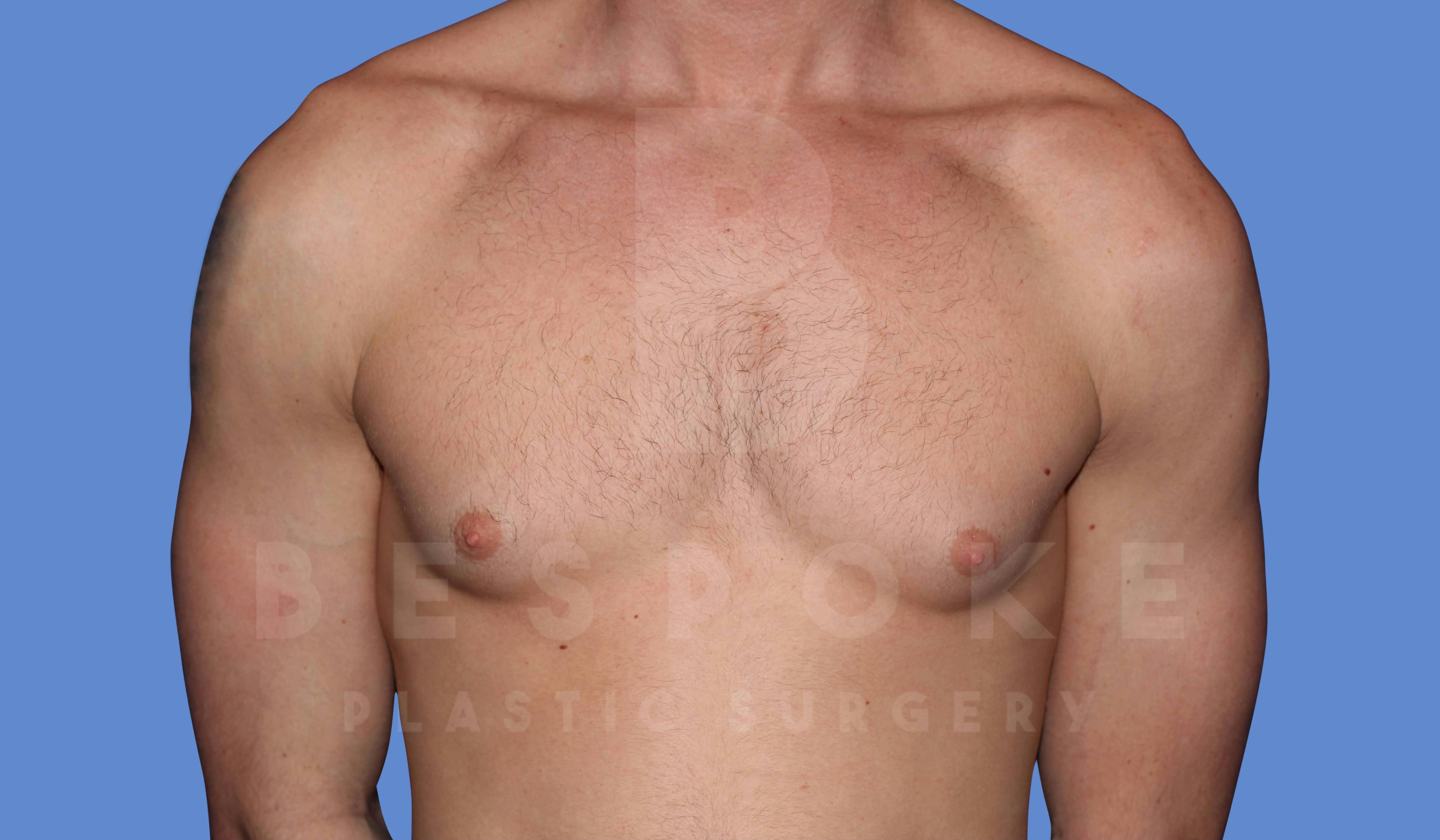 Gynecomastia Before & After Gallery - Patient 143773712 - Image 1