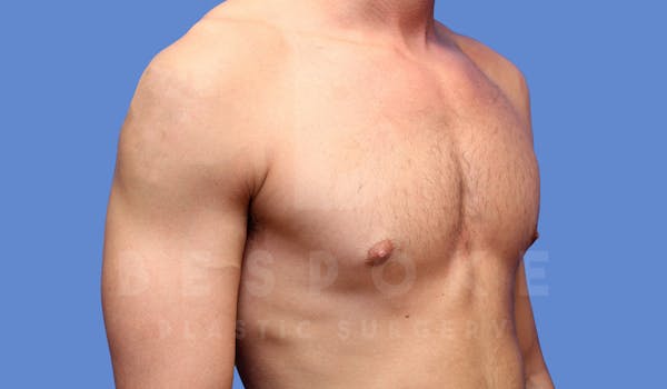 Gynecomastia Before & After Gallery - Patient 143773712 - Image 4