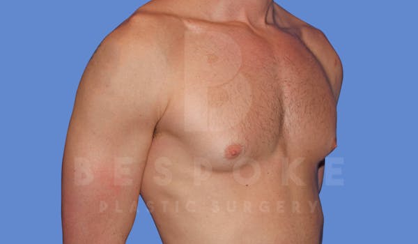 Gynecomastia Before & After Gallery - Patient 143773712 - Image 3