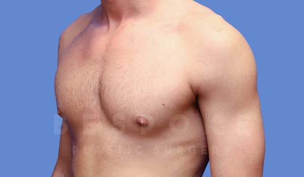 Gynecomastia Before & After Gallery - Patient 143773712 - Image 6