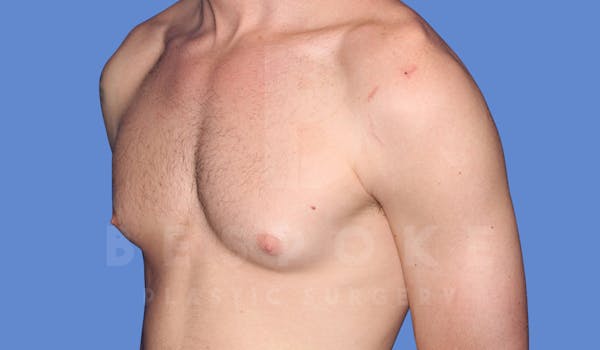 Gynecomastia Before & After Gallery - Patient 143773712 - Image 5