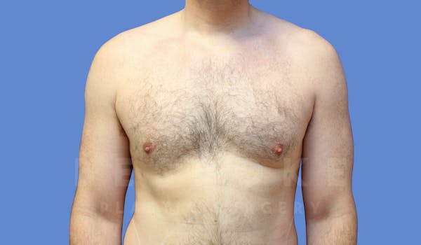 Gynecomastia Before & After Gallery - Patient 143773713 - Image 2