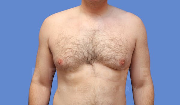 Gynecomastia Before & After Gallery - Patient 143773713 - Image 1