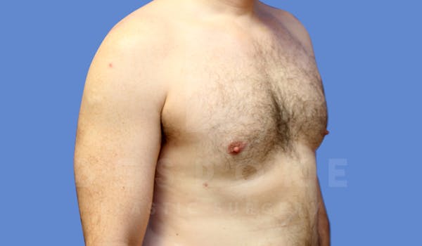 Gynecomastia Before & After Gallery - Patient 143773713 - Image 4