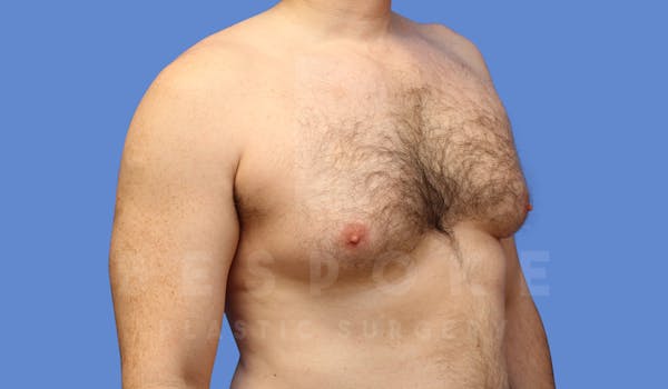 Gynecomastia Before & After Gallery - Patient 143773713 - Image 3