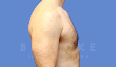 Gynecomastia Before & After Gallery - Patient 143773713 - Image 6