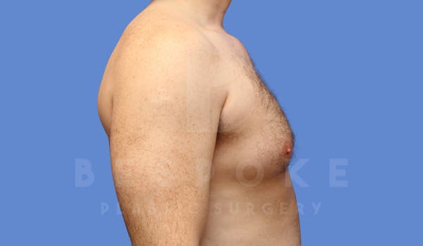 Gynecomastia Before & After Gallery - Patient 143773713 - Image 5