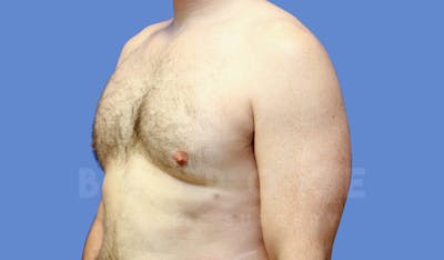 Gynecomastia Before & After Gallery - Patient 143773713 - Image 8