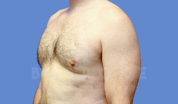 Gynecomastia Before & After Gallery - Patient 143773713 - Image 8