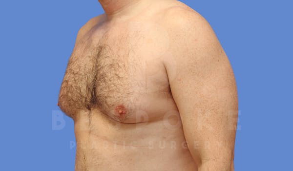 Gynecomastia Before & After Gallery - Patient 143773713 - Image 7
