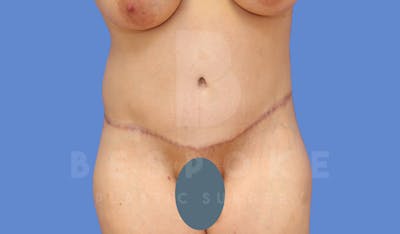 Tummy Tuck Before & After Gallery - Patient 143773821 - Image 2