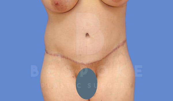 Tummy Tuck Before & After Gallery - Patient 143773821 - Image 2