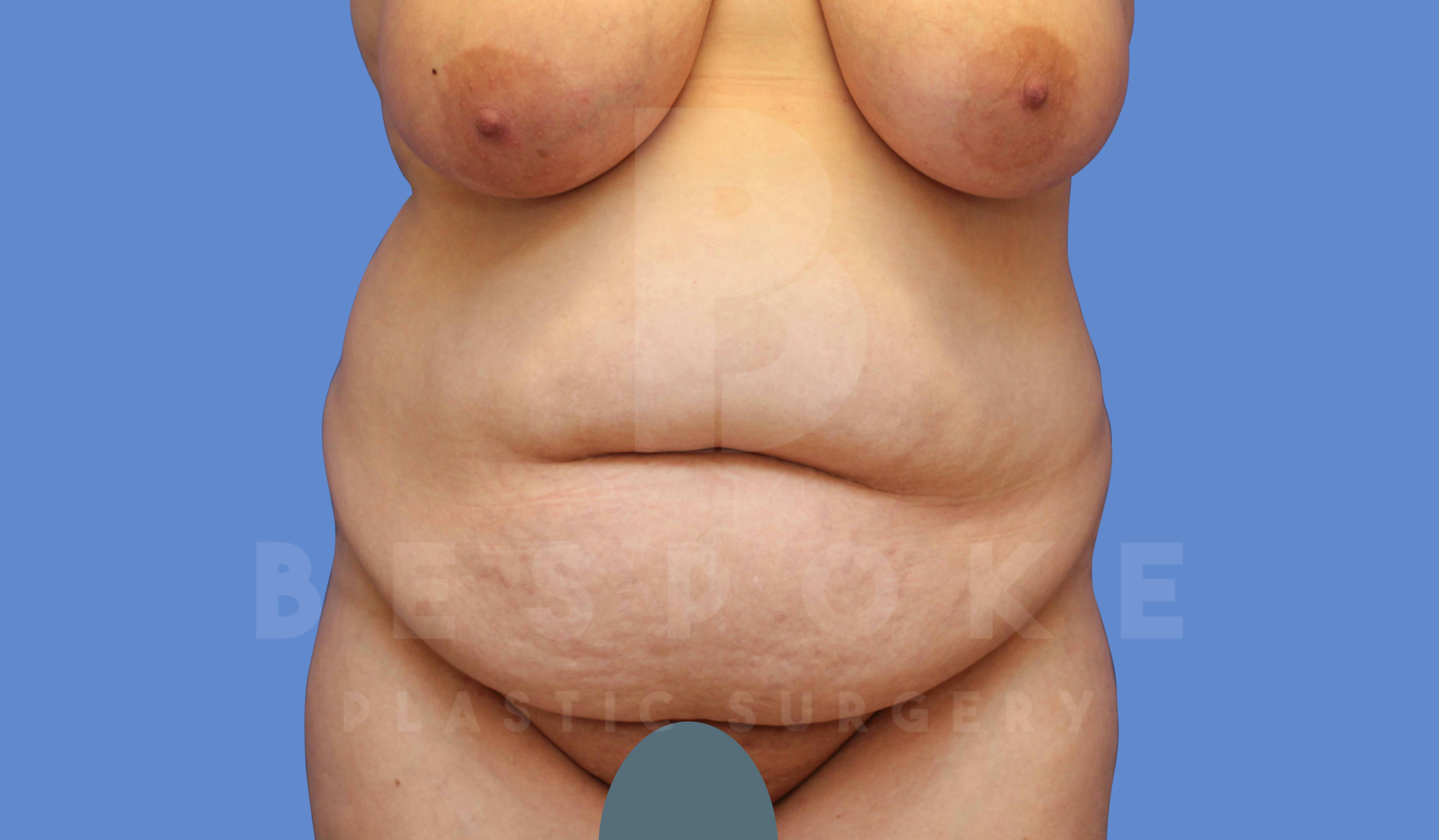 Tummy Tuck Before & After Gallery - Patient 143773821 - Image 1