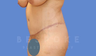 Tummy Tuck Before & After Gallery - Patient 143773821 - Image 4