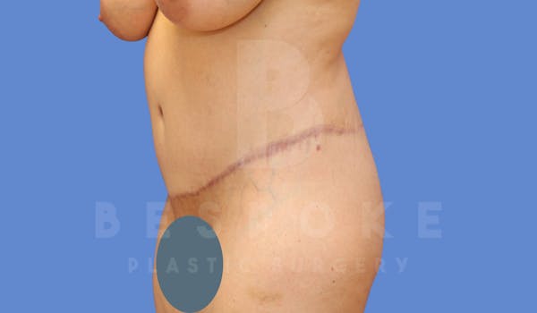 Tummy Tuck Before & After Gallery - Patient 143773821 - Image 4