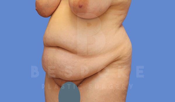Tummy Tuck Before & After Gallery - Patient 143773821 - Image 3