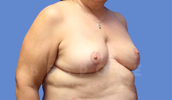 Breast Reduction Before & After Gallery - Patient 143773829 - Image 2