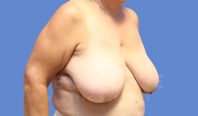 Breast Reduction Before & After Gallery - Patient 143773829 - Image 1