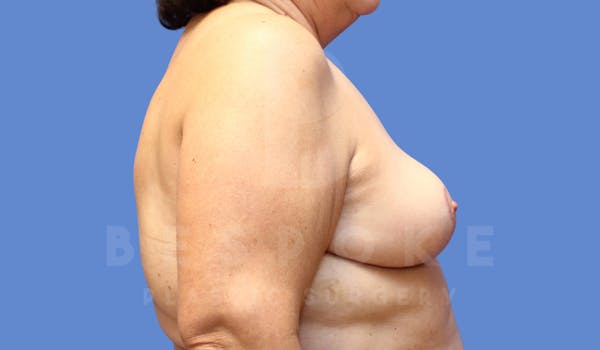 Breast Reduction Before & After Gallery - Patient 143773829 - Image 4