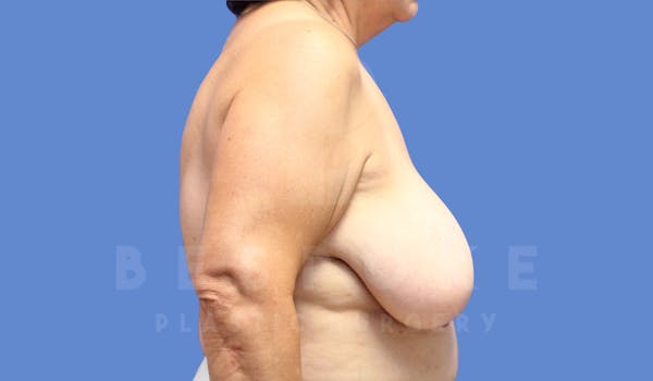 Breast Reduction Before & After Gallery - Patient 143773829 - Image 3