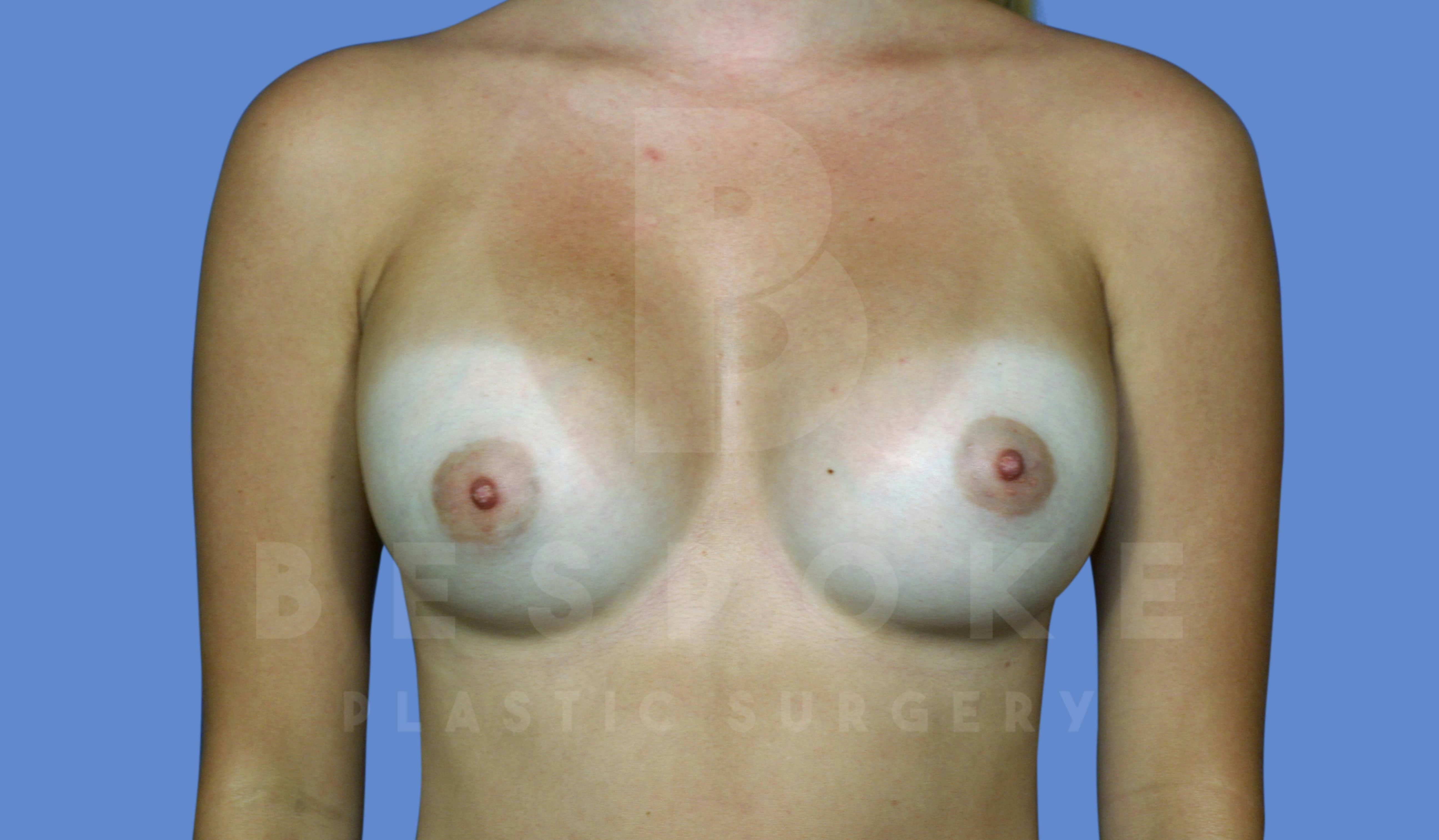 Breast Augmentation Before & After Gallery - Patient 143774040 - Image 2