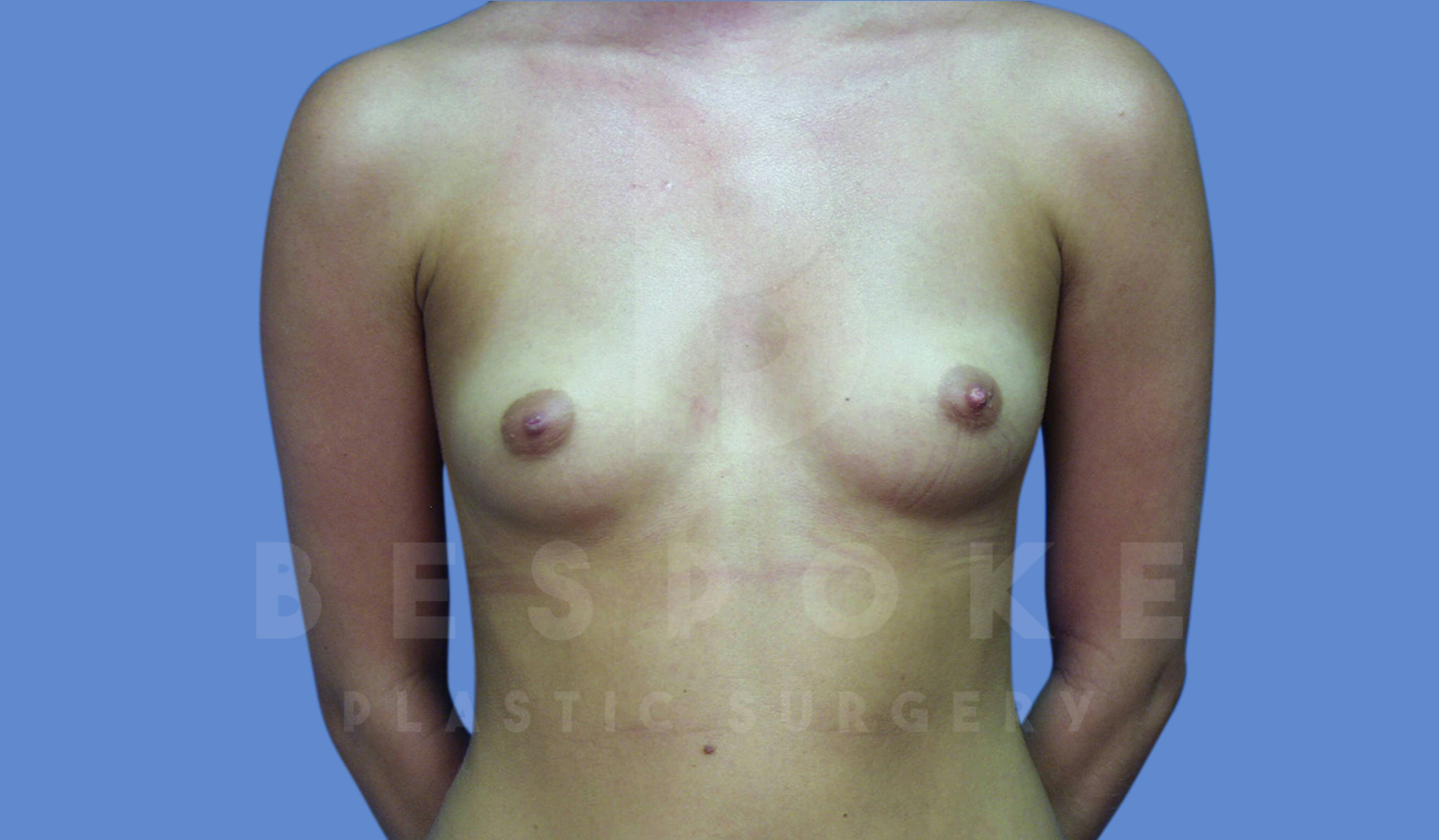 Breast Augmentation Before & After Gallery - Patient 143774040 - Image 1