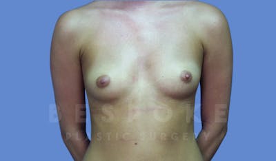Breast Augmentation Before & After Gallery - Patient 143774040 - Image 1