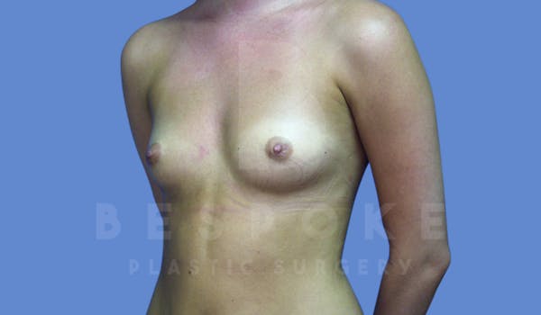 Breast Augmentation Before & After Gallery - Patient 143774040 - Image 3
