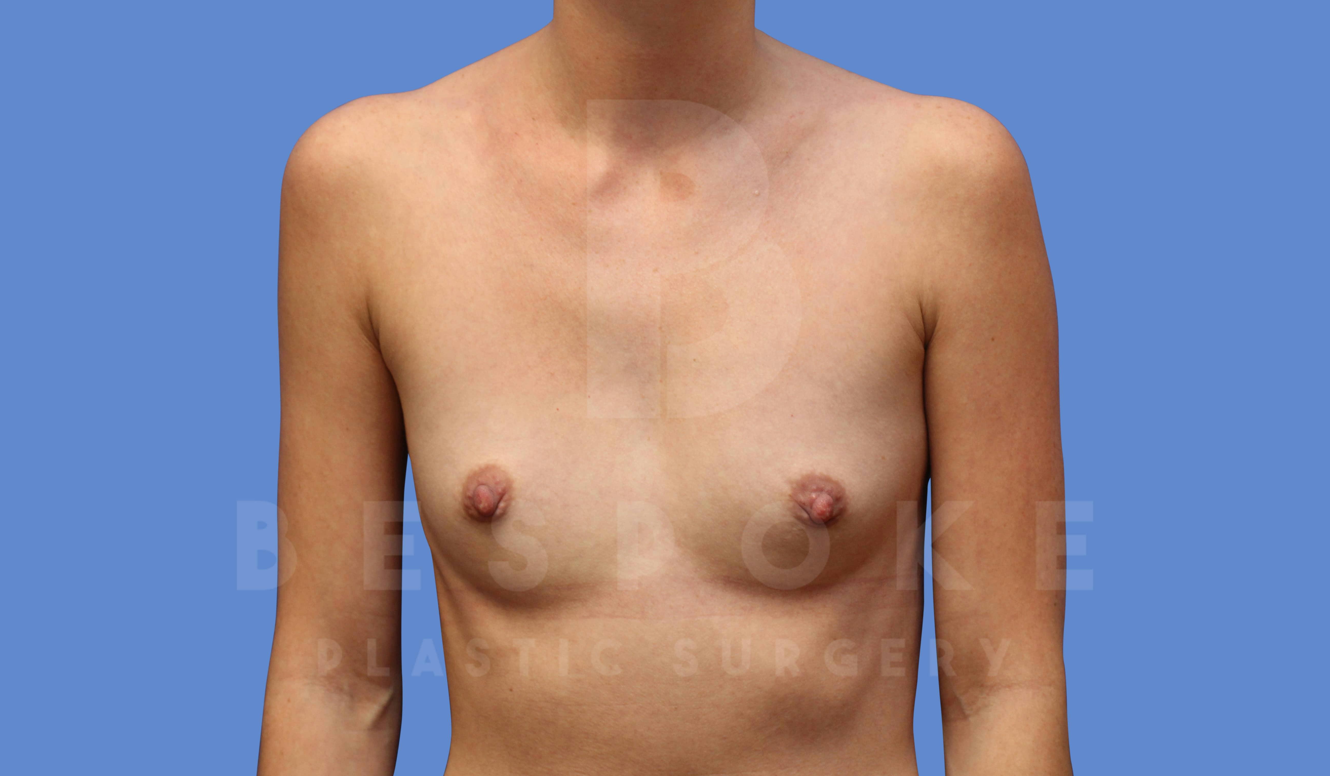 Breast Augmentation Before & After Gallery - Patient 143774041 - Image 1