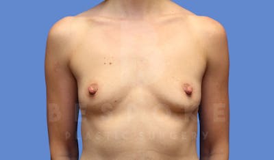 Breast Augmentation Before & After Gallery - Patient 143774042 - Image 1