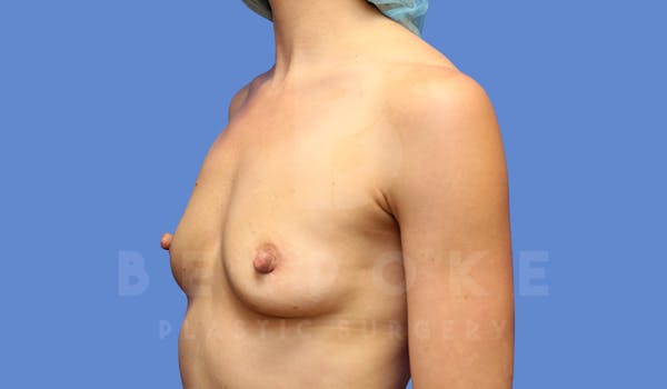Breast Augmentation Before & After Gallery - Patient 143774042 - Image 3