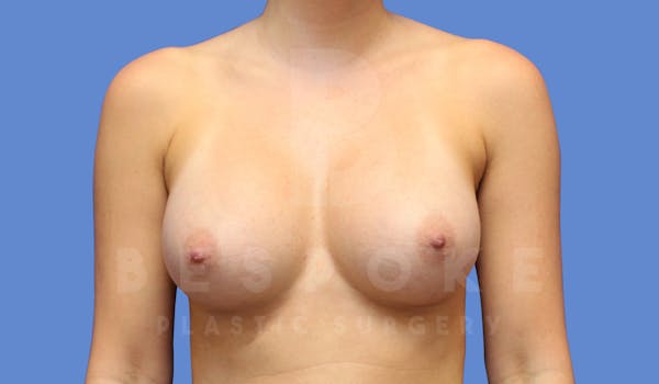 Breast Augmentation Before & After Gallery - Patient 143774043 - Image 2