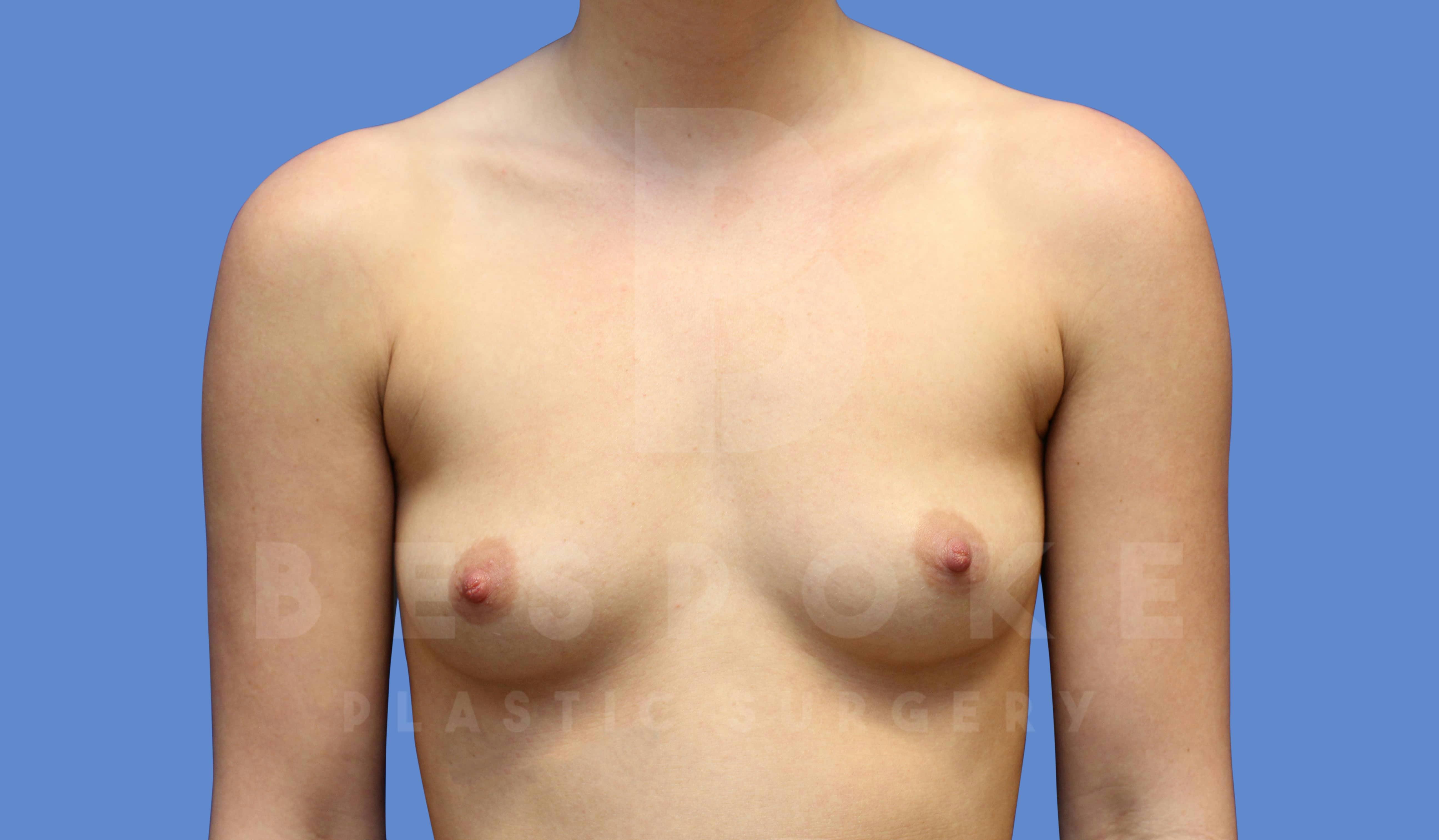 Breast Augmentation Before & After Gallery - Patient 143774043 - Image 1