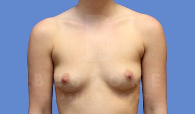 Breast Augmentation Before & After Gallery - Patient 143774043 - Image 1