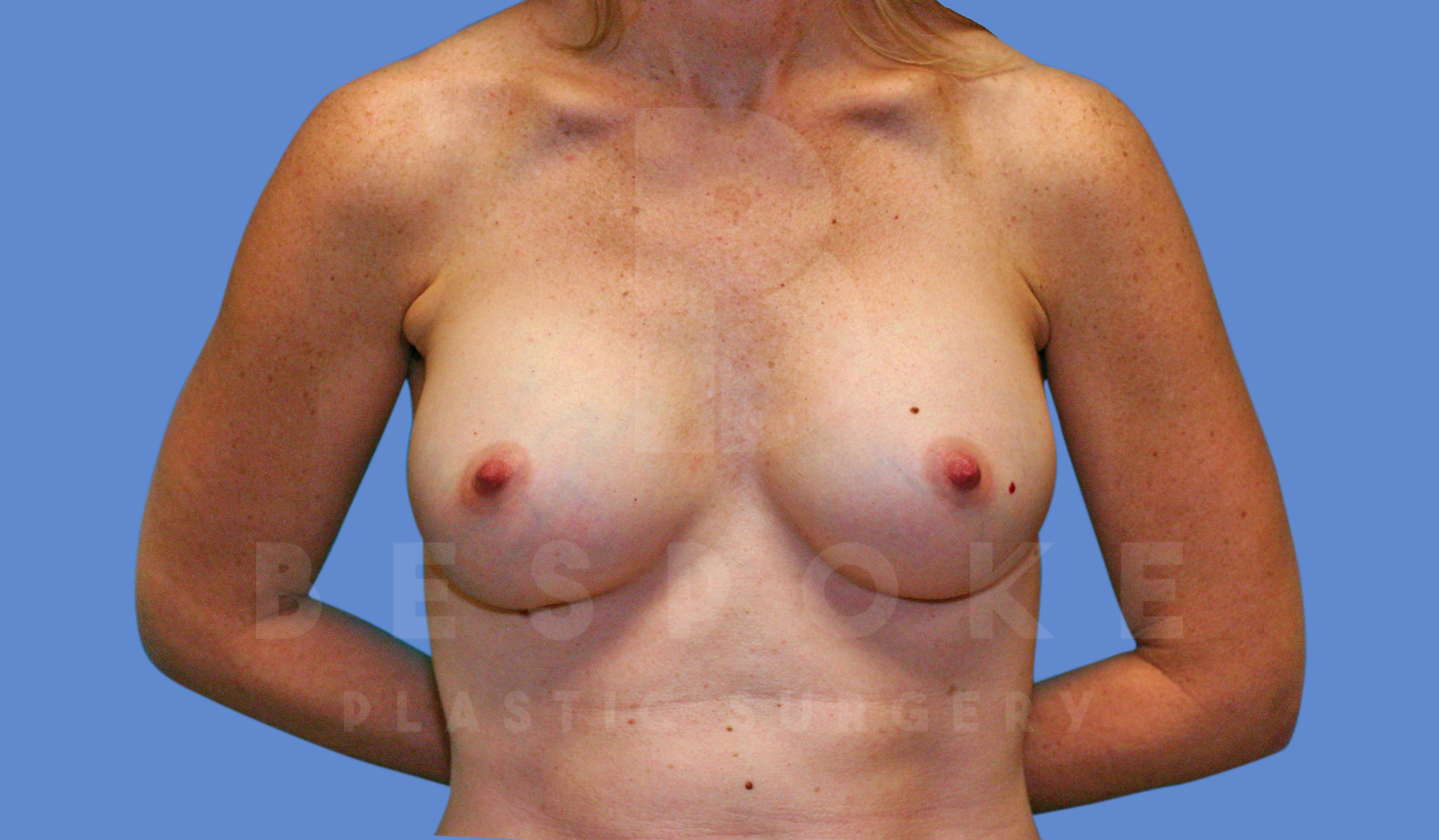 Breast Augmentation Before & After Gallery - Patient 143774044 - Image 2