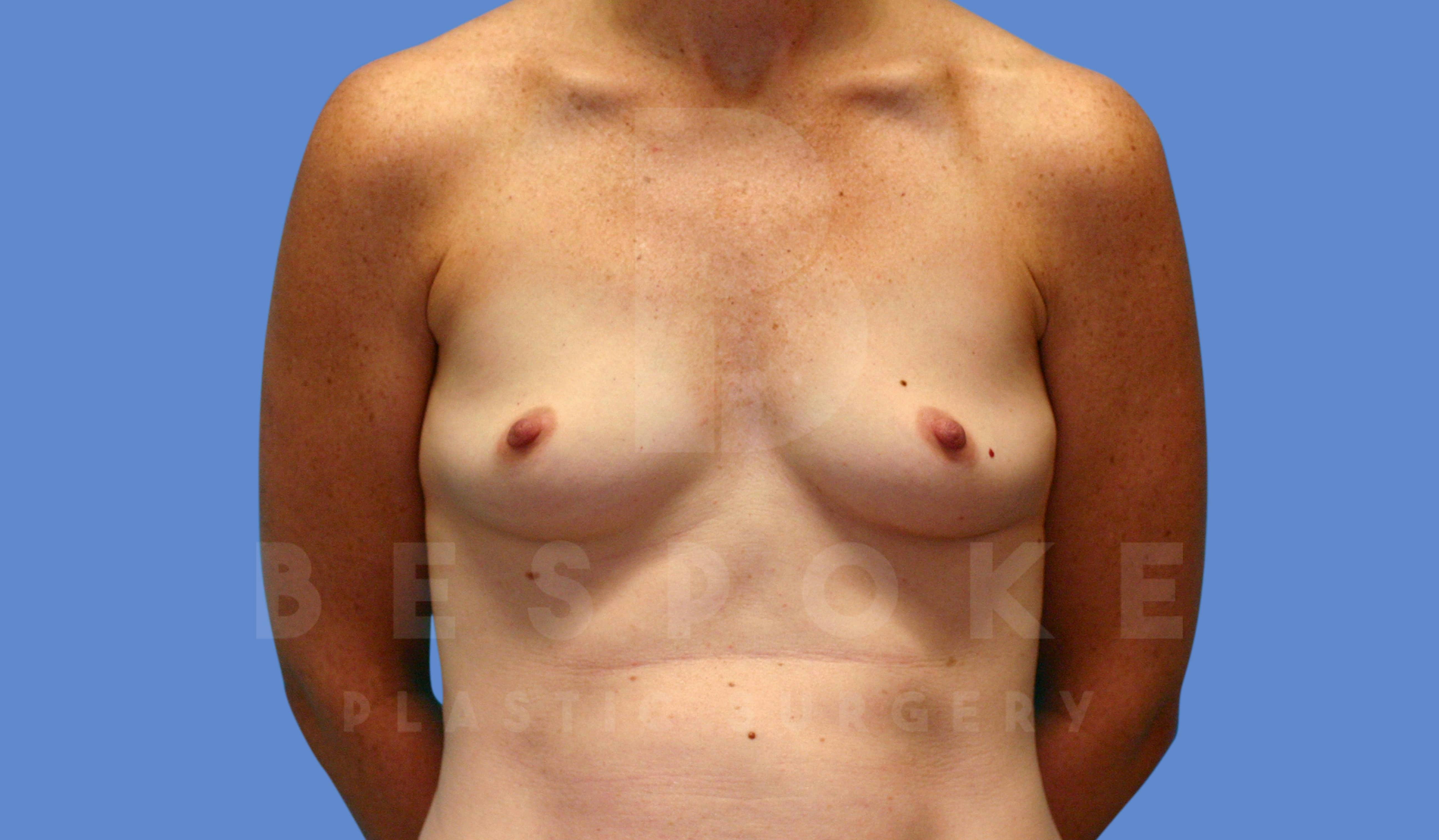 Breast Augmentation Before & After Gallery - Patient 143774044 - Image 1