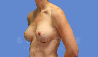 Breast Augmentation Before & After Gallery - Patient 143774044 - Image 4