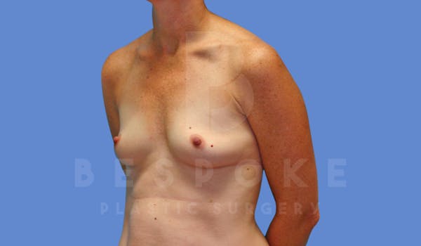 Breast Augmentation Before & After Gallery - Patient 143774044 - Image 3