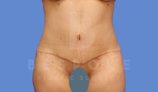 Tummy Tuck Before & After Gallery - Patient 143775180 - Image 2